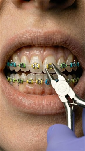 Braces Before and After Transformation