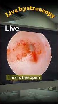 Live Hysteroscopy: Exploring the Uterus from Inside