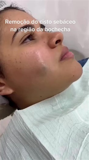 Cisto Sebáceo: Como Identificar e Tratar