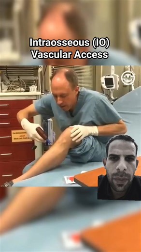 Intraosseous (IO) access | Mohamed Kaneer