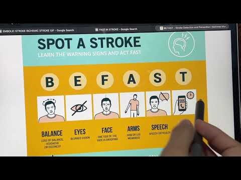 CVA/Stroke Simplified 🚑 | Must-Know NCLEX & NORCET Review #dhs 