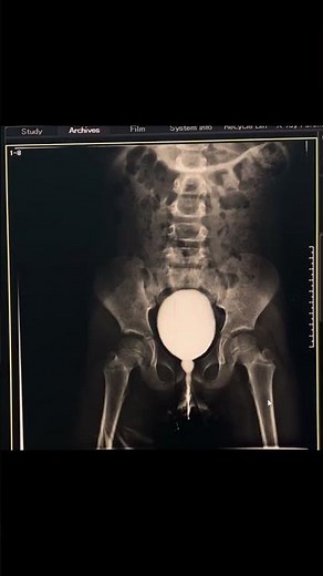 Micturating Cystourethrogram #fluoroscopy #medicaleducation #radiology #medicalimaging