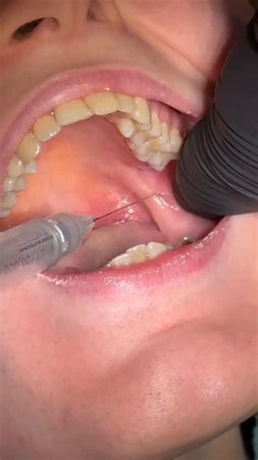 Dr.Adyan on Instagram: "The inferior alveolar nerve block (IANB)"