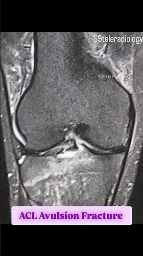 ACL Avulsion Fracture #radiology #anatomy #kneeinjury #kneepain #trauma #medicaleducation #msk #mri