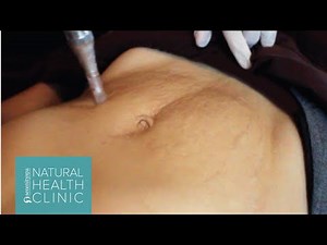 Micro-Needling: Treatment for Stretch Marks