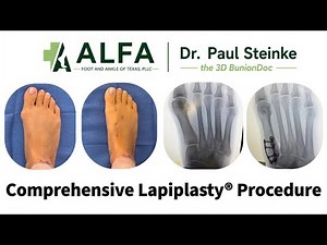 Lapiplasty® Bunion Correction Step-by-Step | Complete 3D Bunion Correction Procedure
