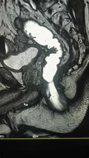 80K views · 327 reactions | Mri Defecography #Today_work #Semenase_machine | Radiology - 1895 | Facebook