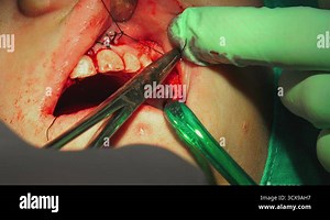 Dentist stitches women gum after tooth surgical operation of cyst removal Stock Video Footage - Alamy