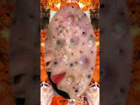 Blackheads Removal #624 | Acne Treatment and Very Satisfying Satisfying Pimple pop #blackheads