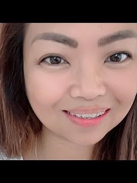 Preempt Protocol Treatment for Severe Migraine (31 injections), King's College Hospital, Dubai UAE