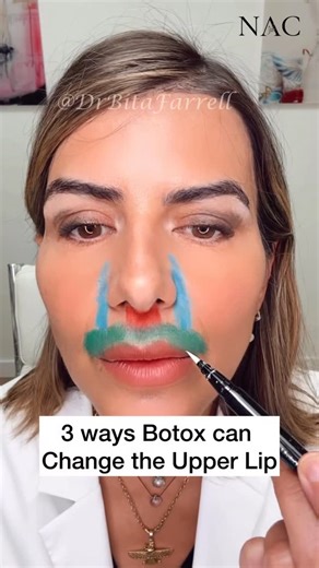 Dr. Bita Zadeh Farrell on Instagram: "3 Ways Botox Can Change the Upper Lip 1. Injection into the orbicularis oris (OO) known as a lip flip, can make the upper lip appear fuller while also softening vertical lip lines. 2. Injection into the depressor septi nasi (DSN) can drop the mid-upper lip. This muscle normally shortens the upper lip, so relaxing it with Botox can both drop the lip and create a subtle nasal tip lift. 3. Injection into the LLSAN (levator labii superioris alaeque nasi) can dro