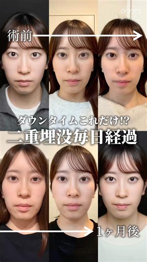 【20代女性 二重埋没 二重整形ダウンタイム経過】#二重埋没 #二重整形 #二重整形経過 #二重埋没法 #rootsclinic
