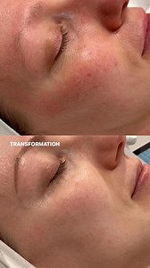 Rosacea isn’t always easy - but expert support can make a difference. A tailored approach to rosacea-prone skin starts with a customised home routine, builds with signature facials, and is supported by LED light therapy to help calm and rebalance the skin over time. Every journey is unique. We're here to guide yours with personalised care and proven protocols. Book your complimentary skin consultation today and take the first step toward calmer, more confident skin. | Contour Clinics