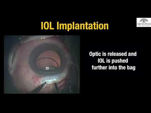 Rigid IOL implantation in MSICS