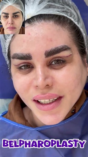 🔥 Upper Eyelid Blepharoplasty Before & After | Stunning Transformation