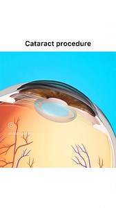 Cataract Surgery Animation | Medical Talks