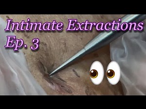 Intimate Extractions Ep. 3 | Bk Beauty Spa