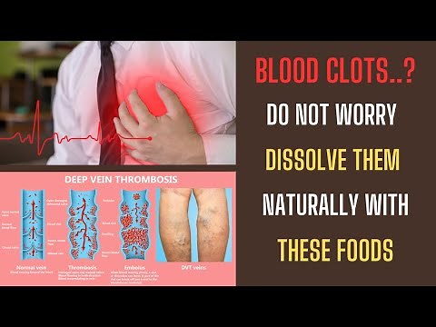 BEST 12 Foods to Dissolve Blood Clots Naturally Without Medication