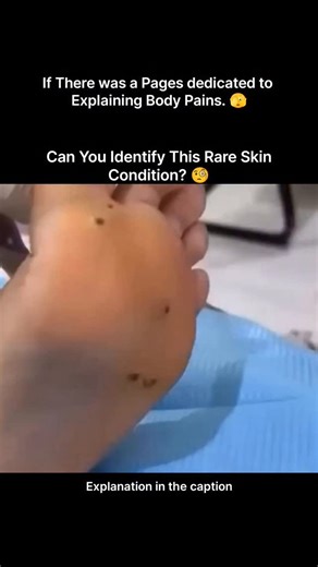 Explaining Biology on Instagram: "an unusual skin presentation that often sparks curiosity and confusion. At first glance, it may look like a simple spot or small opening, but such lesions can indicate an underlying biological or dermatological condition. These tiny pits or holes may be associated with clogged pores, parasitic infestations, chronic infections, or rare skin disorders that affect the deeper layers of tissue. In some cases, pressure, inflammation, or foreign material trapped under