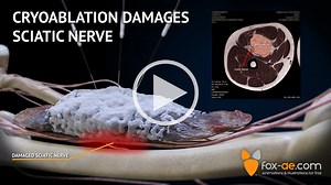 Cryoablation Damages Sciatic Nerve
