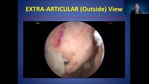 My Technique: Arthroscopic Subscapularis Repair - Outside View
