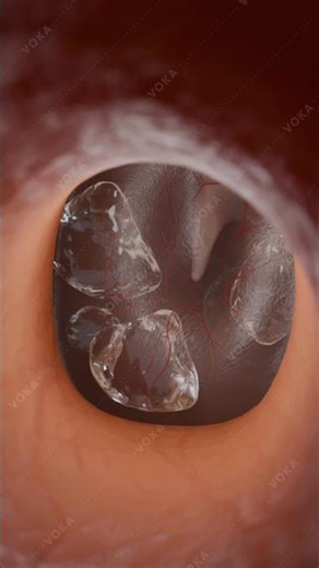 What Happens When Chronic Otitis Media with Effusion Goes Untreated? Explore in 3D