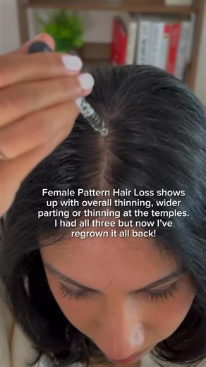 Female pattern hair loss isn’t caused by just one thing. It’s usually a mix of: • follicle miniaturisation driven by DHT sensitivity • hormonal shifts • shortened growth cycles • scalp inflammation • reduced blood flow • nutrient signalling issues So treating it with a single product? Rarely enough. That’s why dermatology-led care focuses on combination therapy. Instead of one active, multiple clinically studied ingredients are layered into a personalised formula, each targeting a different part