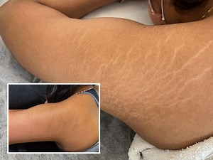 Stretch Mark Removal: How Does It Work And Is It Safe?