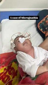 A case of Micrognathia , briefly discuss its causes ,signs symptoms , diagnosis and management 🩺