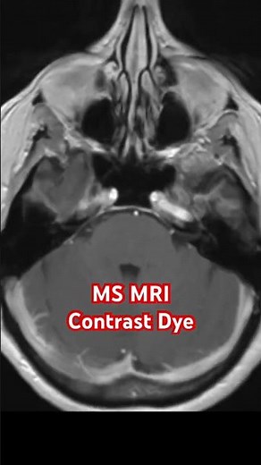 MS MRI Contrast Dye