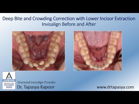 Deep Bite and Crowding Correction with Lower Incisor Extraction - Invisalign Before and After
