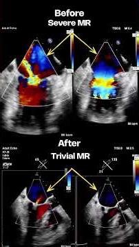 5 TEER Procedures in 1 Month | Advanced MyClip & Tricuspid Valve Repair at HVS Dadar (Symbiosis)