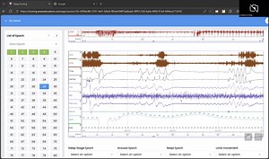 How to measure respiratory wave amplitude using grid ruler