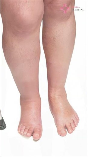 Varicose Veins: Causes, Symptoms & Treatment | Explained by an Expert | CK Birla Hospital