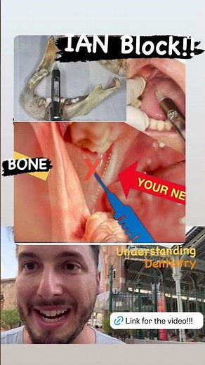 Inferior Alveolar Nerve Block (The main Secrets!!) #dentalstudents #dentalvideos