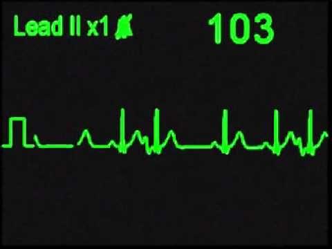 Atrial Trigeminy - ECG Simulator - Arrhythmia Simulator