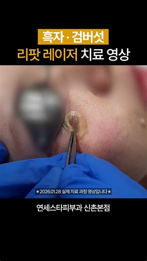 이게 되네? 평생 고민이던 흑자, 1분 만에 박멸