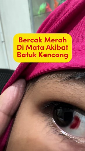 Mata Merah: Penyebab, Gejala, dan Pengobatan