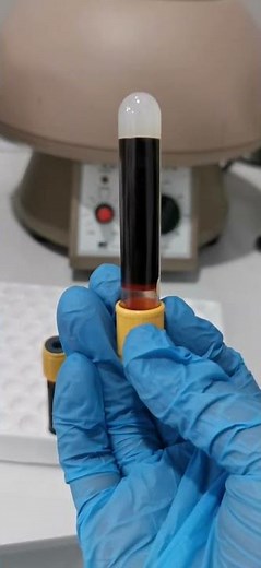 Stages of Serum Separator Tube #phlebotomy #laboratory #SST #medtechstudent #cls #mls #bloodserum