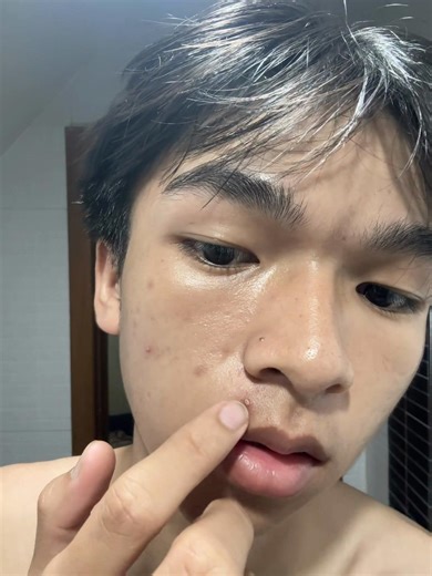 Skincare Update on Auna Acen Serum