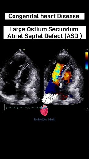 Large Ostium Secundum ASD #AtrialSeptalDefect #LargeASD #OstiumSecundum #echocardiography #2decho