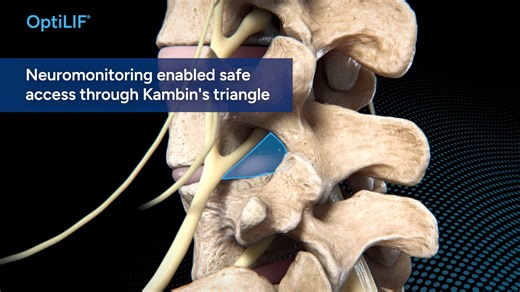 OptiLIF® with the OptiMesh® Expandable Interbody Fusion System