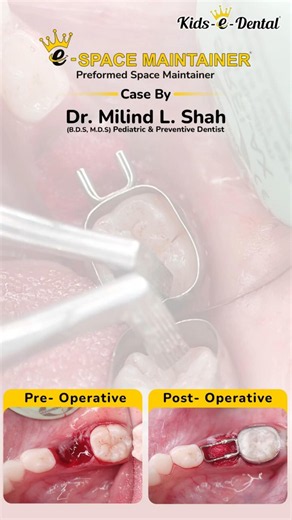 e-Space Maintainer Clinical Demonstration by Dr. Milind Shah | Space Maintainer | Kids e Dental