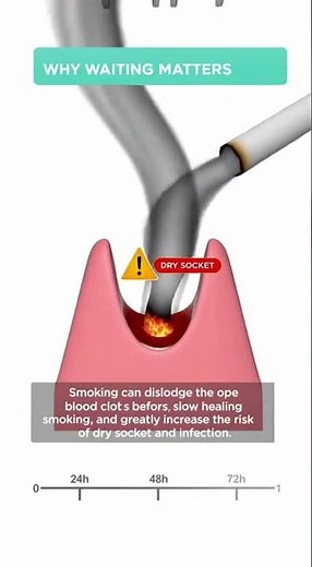 🚭🦷 When Can You Smoke After a Tooth Extraction?