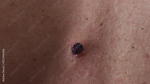 Mole treatment after cryotherapy. Dying seborrheic keratosis. Macro close up