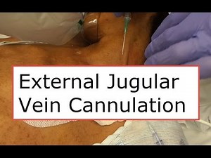 How to cannulate the external jugular vein