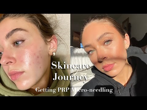Skincare Journey part 1: Getting PRP Micro-Needling 💉🩸