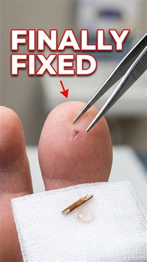 The right way to get that splinter out #health #firstaid #tips