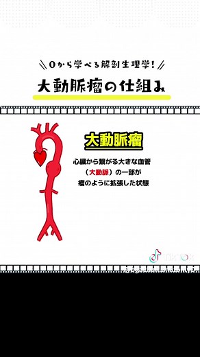 【大動脈瘤の仕組み】 #医療学生 #解剖生理学 #インストラクター #セラピスト #マッサージ #看護 #看護学生 #整体 #解剖学 #解剖学の勉強 #過去問 #大動脈解離 #大動脈瘤 #動脈瘤