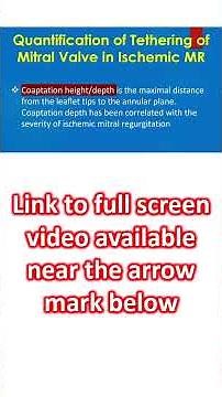 Quantification of Tethering of Mitral Valve in Ischemic MR